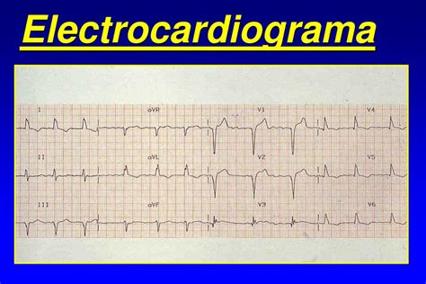 PPT INSUFICIENCIA CARDIACA CONGESTIVA PowerPoint Presentation Free