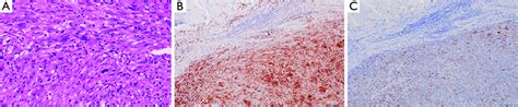 Pathology of resected PPC. (A) Hematoxylin and eosin staining at an... | Download Scientific Diagram