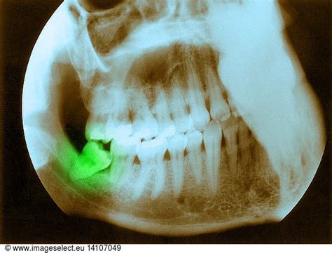 Impacted Wisdom Tooth Impacted Wisdom Toothcolorisedcolorizationx