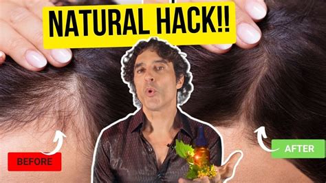 Hair Loss Doctor Tips To Naturally Prevent Hair Loss And Regrow Hair Youtube