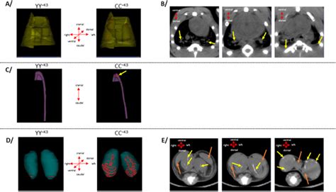 missense mutation  vkorc leads  medial arterial calcification