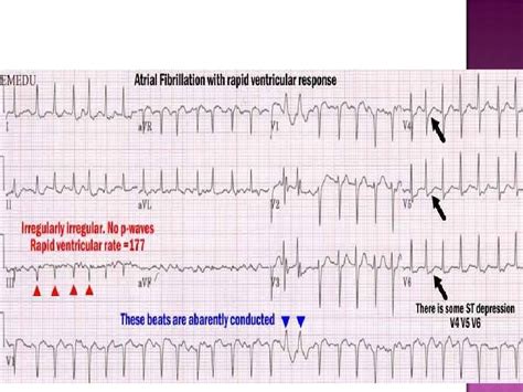 ECG: Multifocal Atrial Tachycardia