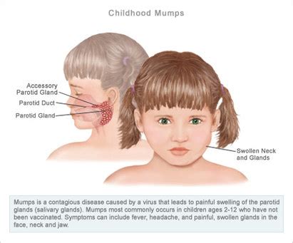 Symptoms - The Mumps