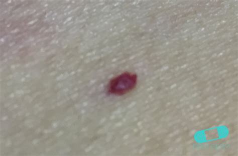 Online Dermatology - Angioma