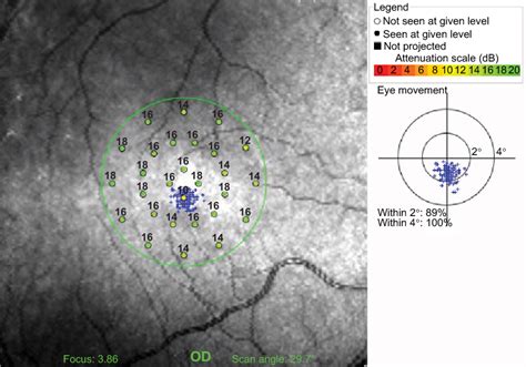 Figure From Clinical Ophthalmology Dovepress Dovepress Semantic Scholar