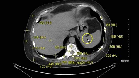 Hu Values Ct Abdomen Pelvis Youtube