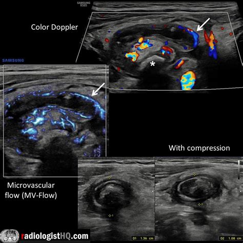 Acute appendicitis on ultrasound : r/Radiology