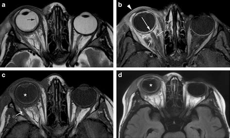 Ct And Mr Imaging Of Orbital Inflammation Springerlink