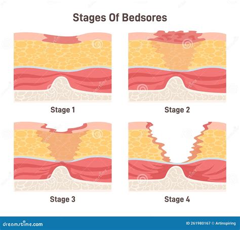 Bedsore Stages Set Pressure Sores Areas On Human Body Parts Stock Vector Illustration Of