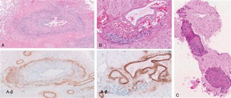 Pathological Findings In Primary Central Nervous System Vasculitis And