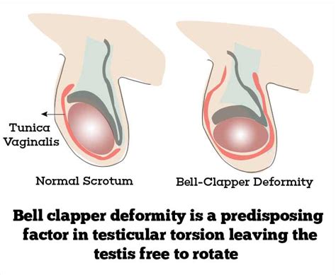 Torsion Testis Causes Risk Factors Symptoms Diagnosis Treatment