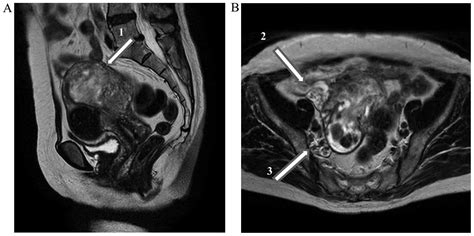 √ Uterus Endometriosis Ct Scan / Tumors Of The Uterine Corpus Clinical ...