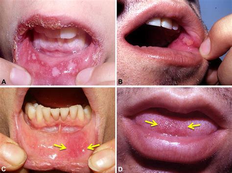 Oral Mucosal Fixed Drug Eruption Characteristics And Differential