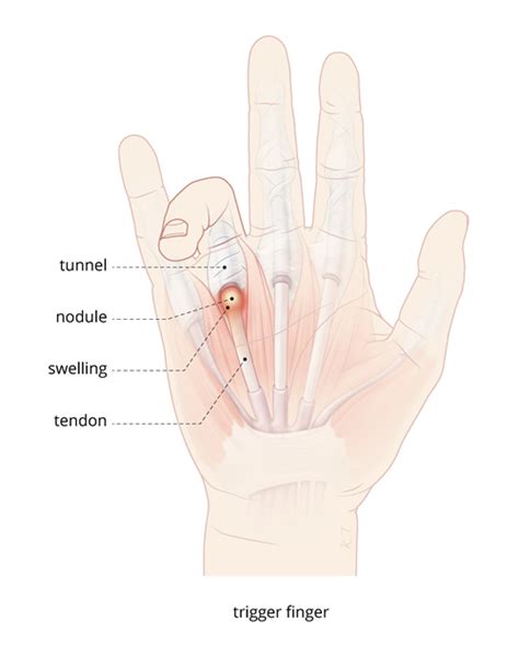 Trigger Finger Surgery Sydney Randwick Plastic Surgery