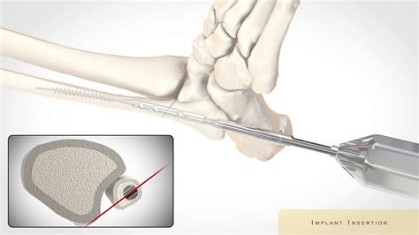 Surgical Frontiers Intrafuse Flexthread Clavicle Pin System Youtube