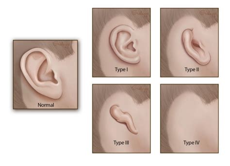 Microtia Otolaryngology Head Neck Surgery Stanford Medicine