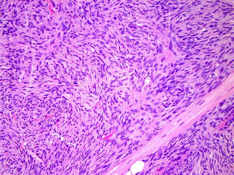 Dermatofibrosarcoma Pathology Outlines