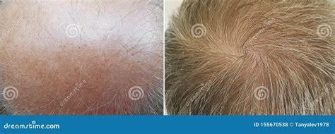 Male Baldness before and after Treatment Stock Photo - Image of ...