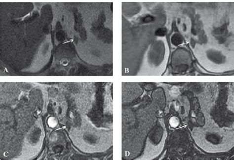 A Follow Up Magnetic Resonance Image Examination Performed 6 Years