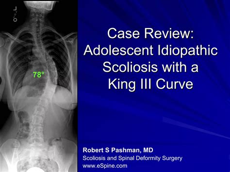 Case Presentation1 20 Year Old Female With Adolescent Idiopathic