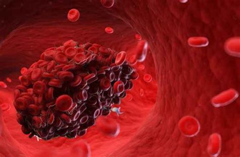 8 Factors that increase your risk of developing blood clots - ELSiEiSY blog