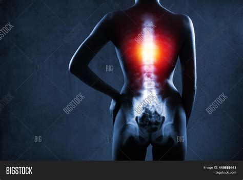 Human Spine X-ray On Image & Photo (Free Trial) | Bigstock