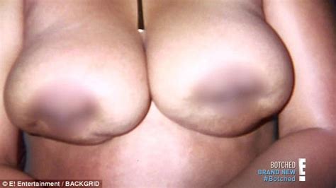 E Botched Patient Celebrates New Breasts With A Boob Cake Daily Mail Online