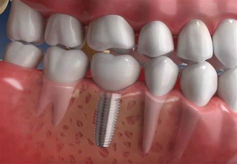 Problemas dolores y complicaciones de los implantes dentales Clínica