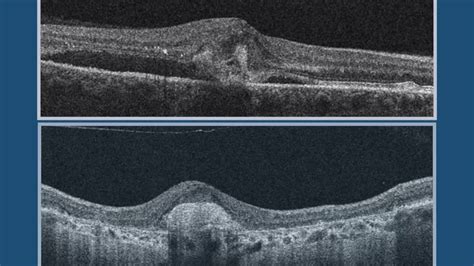 Active Choroidal Neovascularization CNV Vs Inactive CNV And Or Scar