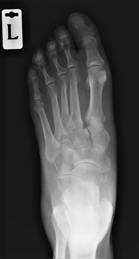 Lisfranc Injury Image