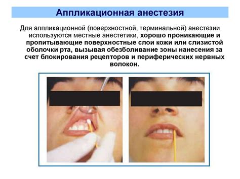 Неинъекционная анестезия слизистой оболочки полости рта ...