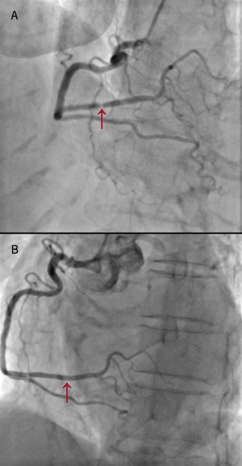 Dr Joshua Walinjom On Twitter Coronary Vasospasm In Takotsubo