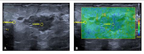 Pdf Application Of Elastography In The Diagnosis Of Idiopathic