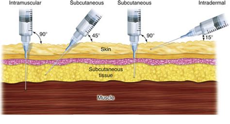 NSG 1600 Intramuscular Subcutaneous Injections Flashcards Quizlet