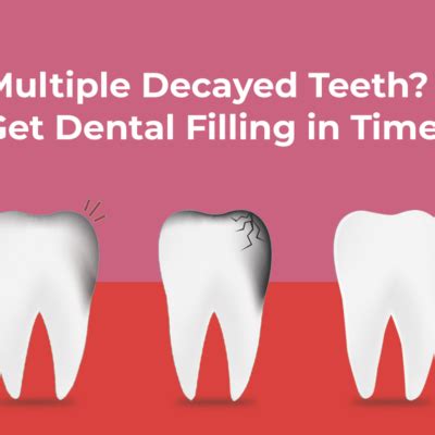 Implanting Diamonds on Teeth - Royal Dental Clinics Blog