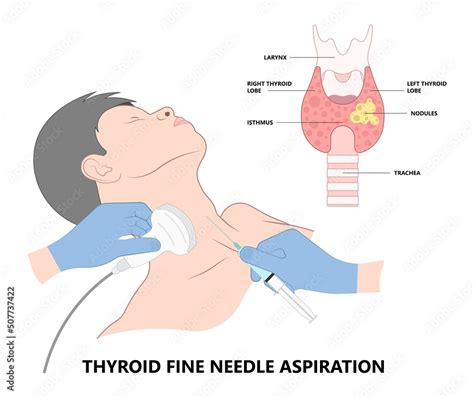 Thyroid Cancer Disease Nodules Ultrasound Screening Check Medical Treat Fine Needle Aspiration