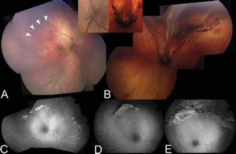 Peripheral Nonperfusion And Tractional Retinal Detachment Associated