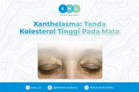 Xanthelasma Tanda Kolesterol Tinggi Pada Mata