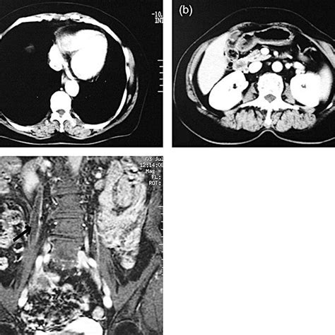 Axial Contrast Enhanced Abdominal Computed Tomography Shows A Small