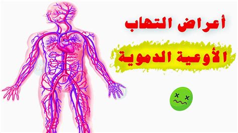 أعراض التهاب الأوعية الدموية Youtube