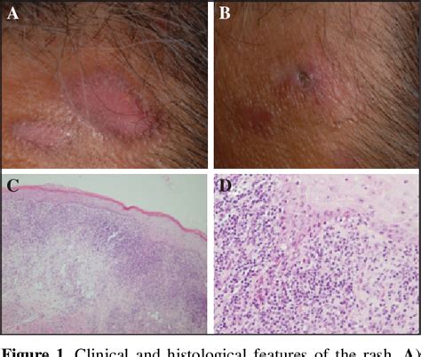 Figure 1 From A Case Of Lichenoid Drug Eruption Induced By Fenofibrate