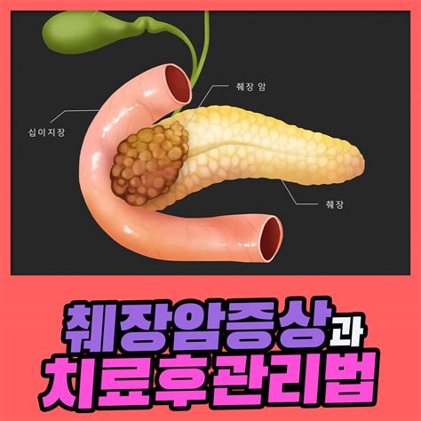 톱 560 췌장암 4 기 생존율 새로운 업데이트 34 일 전