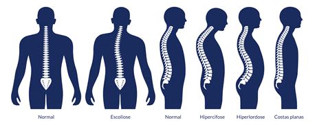 Patologia Osteomioarticular Em Diferentes Segmentos Da Coluna - RETOEDU