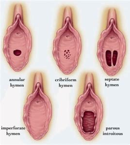 Hymenoplasty Vaginal Tightening Dr Habib Cosmetic Hair Transplant