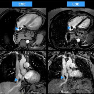 Case 1 Cardiac Magnetic Resonance CMR Hypointense Lesion Entering