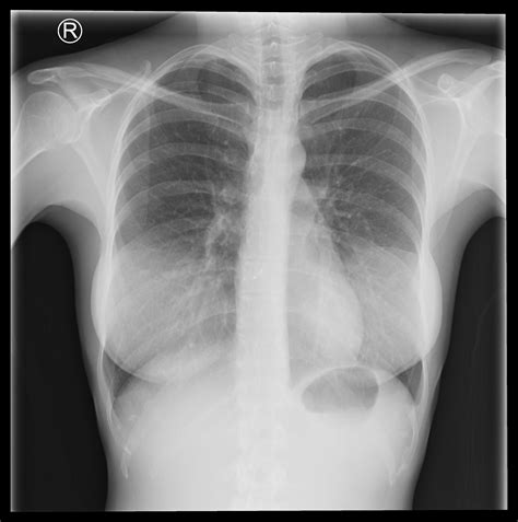 Asd Closure Device Radiograph at Candi Farmer blog