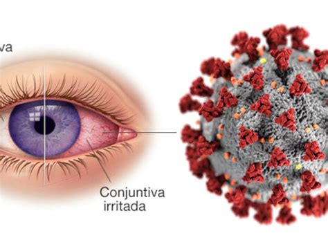 Conjuntivitis actínica