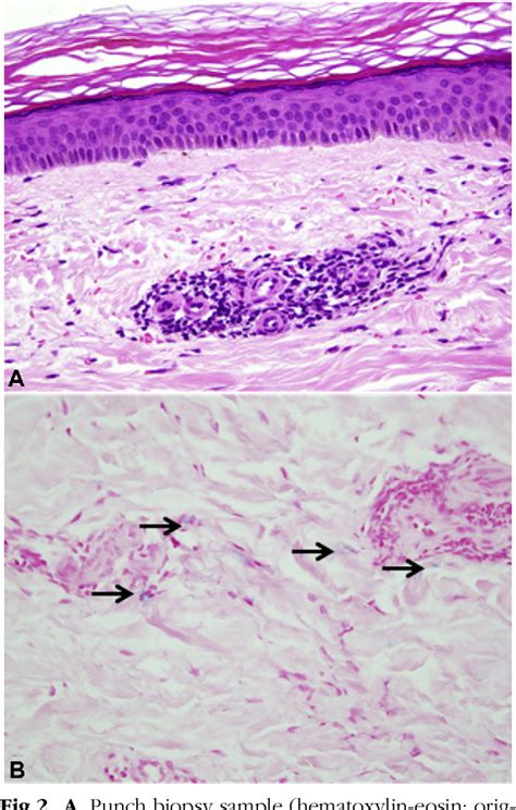 Figure 1 From Sclerotherapy Induced Purpura Annularis Telangiectodes Of