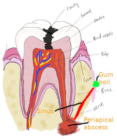 Periapical Abscess With Sinus Vs Without Sinus 1311 Jackson Ave