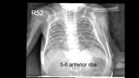 Neonatal Radiography Part Nomal Findings And The Basics Youtube